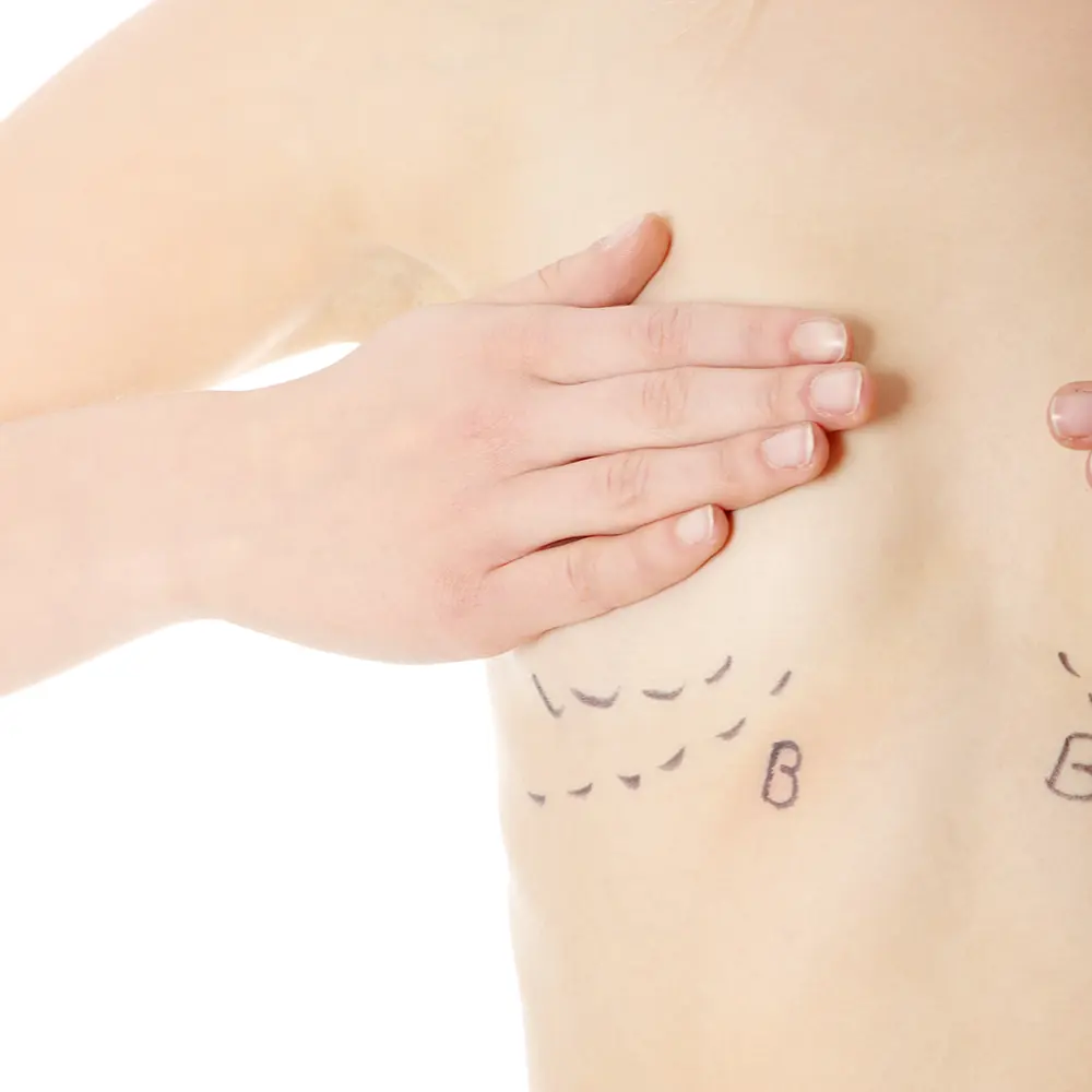 Augmentation-mammaire